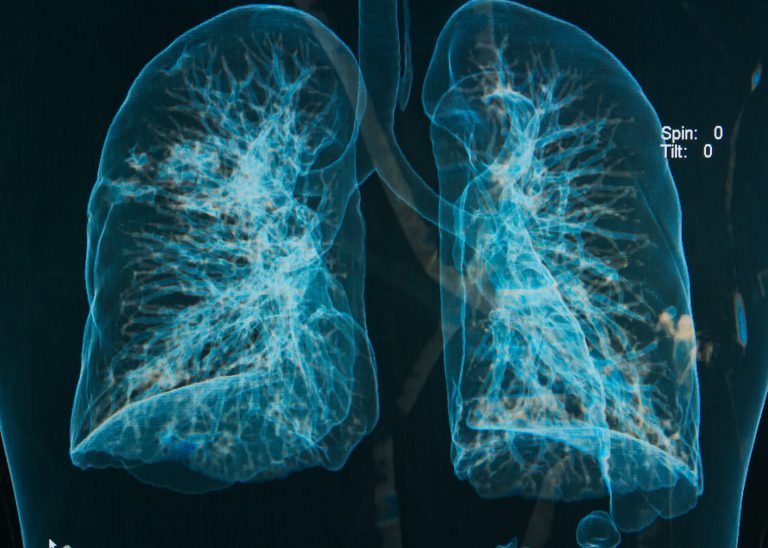 Fat found in overweight people’s lungs