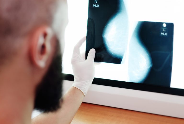Breast cancer may be detected by blood test five years before clinical signs show